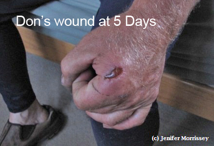 Don wound_5days